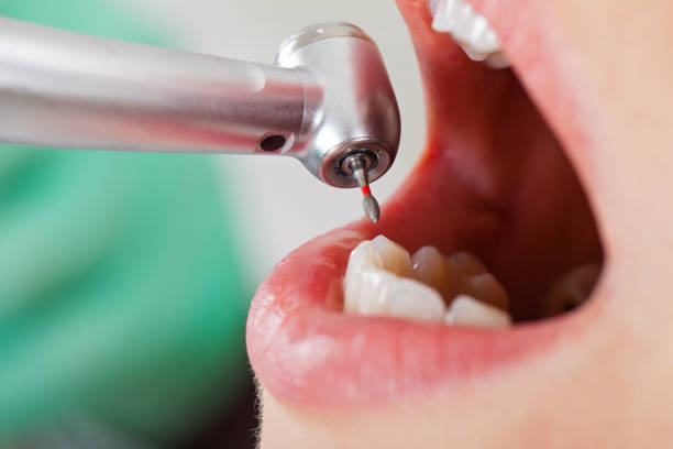Best Emergency Tooth Extraction in Springdale, AR